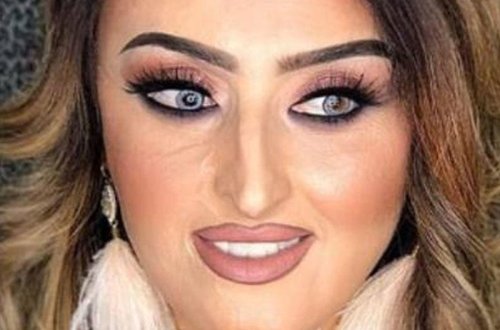 Azərbaycanda üzü tamamilə yanan qızın İNANILMAZ DƏYİŞİMİ