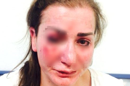 Qadın sərnişinə hücum edib üzünü yumruqladılar, tanınmaz hala saldılar - FOTO