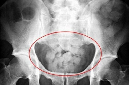 İran vətəndaşının düz bağırsağından çıxanlar hər kəsi təəccübləndirdi - FOTO