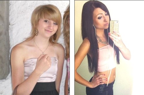 Xarici görünüşünə görə ələ salınan gənc qız estetik əməliyyatlardan sonra tanınmaz halda - FOTOLAR