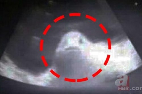 Dünyada GÖRÜNMƏMİŞ HADİSƏ: 17 yaşlı qız balıqdan HAMİLƏ QALDI - FOTOLAR