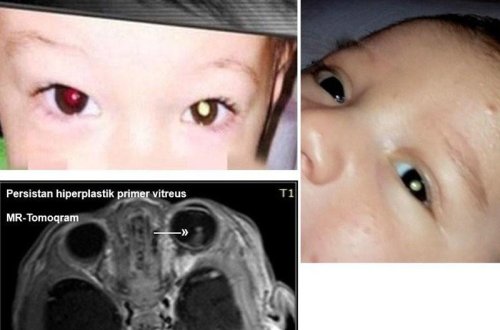 Mobil telefonla çəkdiyi şəkillə körpəsində göz xəstəliyi aşkarladı - FOTO