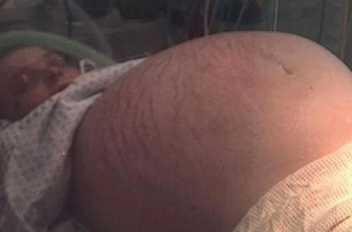 Hamilə olduğu düşünülən qadının qarnından 28 kq-lıq kist çıxarıldı - FOTO