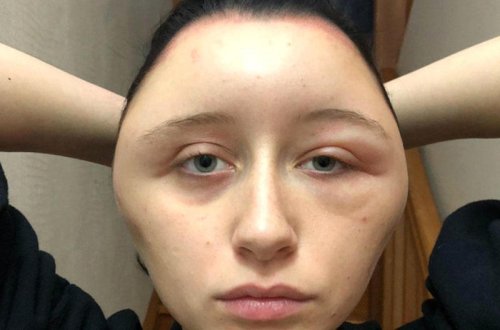 Saç boyasından düzgün istifadə etməyən qızın üzü şişdi - FOTO