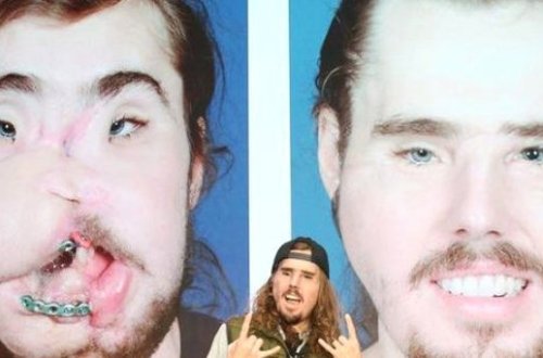 Sifətini gülləylə vurub paramparça etdi - Başqa insanın üzü ilə yenidən həyata qayıtdı - FOTOLAR