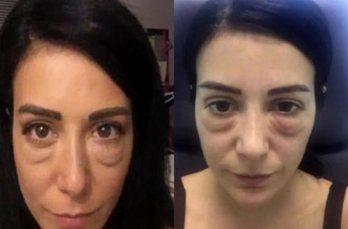 Model estetik qurbanı oldu: Üzü tanınmaz hala düşdü - FOTO