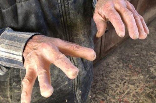 10 barmağını itirdi, sevdiyi peşəni atmadı - Onu görən hər kəs şoka düşür - FOTO