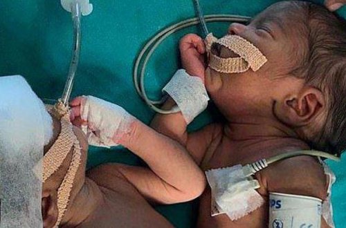 Cərrahlar 3 günlük siam əkizlərini ayıra bildilər - FOTO