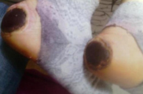 Doğum evində hamilə qadının ayağını yandırdılar - FOTO