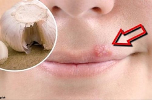 Herpes xəstəliyindən qurtulmağın ən ucuz üsulu – Xalq təbabəti