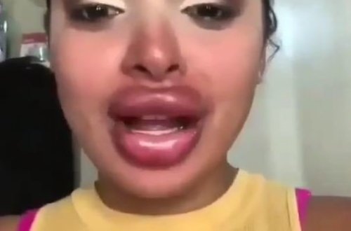 Saxta gel vurulduğu üçün dodağı tanınmaz hala dşüdü - VİDEO