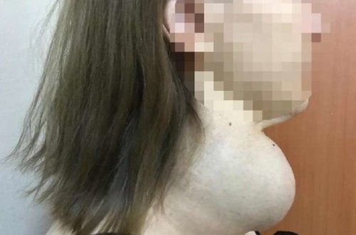 30 il əməliyyat olunmaqdan qorxan qadın bu hala gəldi - FOTO