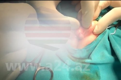 Azərbaycanda görülməmi̇ş hadi̇sə – oğlan uşağını sünnət etdi̇rmək üçün gəti̇rdi̇lər, qız çıxdı