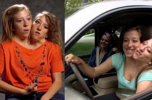 Bu ikibaşlı qadının 3 ağ ciyəri var - FOTO