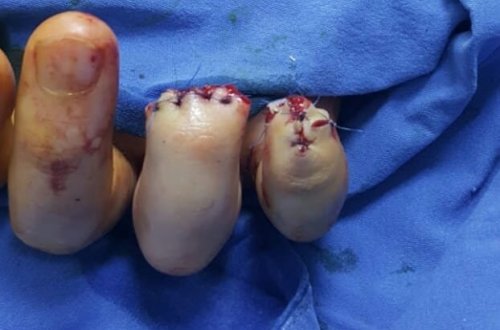 Bakıda əlində pirotexniki vasitə partladı… - Ürəyi zəiflər baxmasın/Fotolar