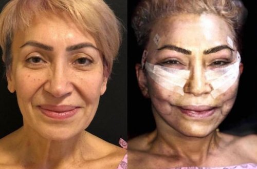 57 yaşlı Əməkdar artistin plastik əməmliyyatdan sonrakı halı - Fotolar