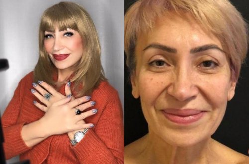 57 yaşlı Əməkdar artistin əməliyyatdan sonrakı halı - Fotolar