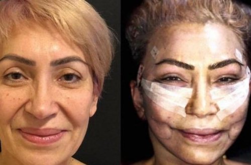 Əməkdar artist estetik əməliyyatlardan sonra ilk dəfə efirə çıxdı - BU DA FOTOLAR