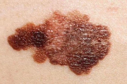 Dərisindəki xərçəngi kəsib atdı - Elə bir şey baş verdi ki.../ VİDEO