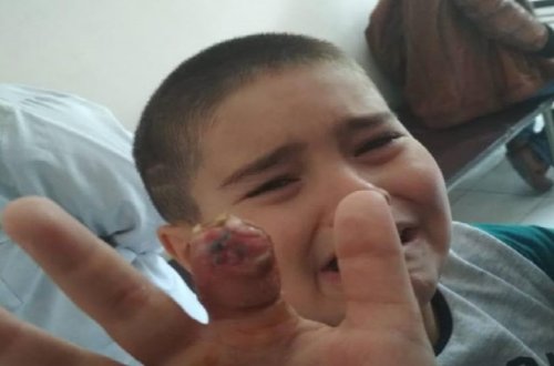 Plastik cərrah Vaqif Qələndərli 8 yaşlı uşağı şikəst edib- iş prokurorluqdadır+FOTOLAR