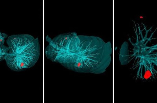 Xərçəngi 20 saniyədə müəyyənləşdirməyin yolu tapıldı