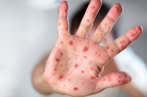 Səhiyyə Nazirliyindən qızılca xəstəliyi ilə bağlı mühüm AÇIQLAMA