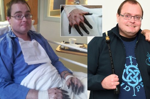 Əl-ayağındakı göyərmələr həyatını kabusa çevirdi, barmaqsız qaldı - Hamıda yarana bilər