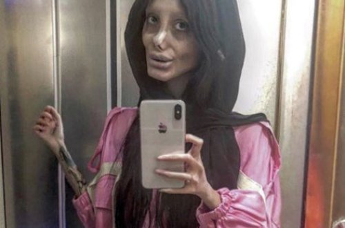 Coliye bənzəmək üçün onlarla əməliyyat etdirən fenomenin 10 il öncəki ŞOK HALI - FOTOLAR