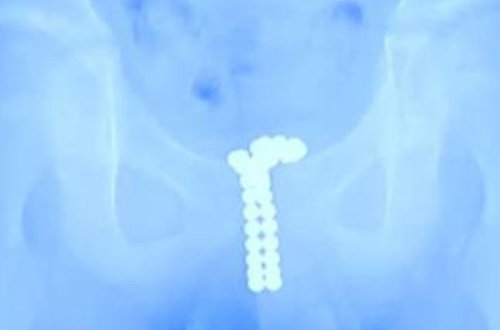 12 yaşlı uşağın cinsiyyət orqanından çıxanlar həkimləri şoka saldı - FOTOLAR