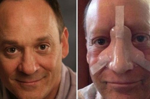 Serial ulduzu burun xərçəngindən öldü