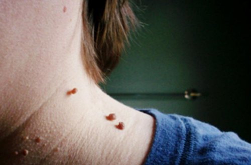 Ət xalllardan qurtulmağın ən təbii üsulu