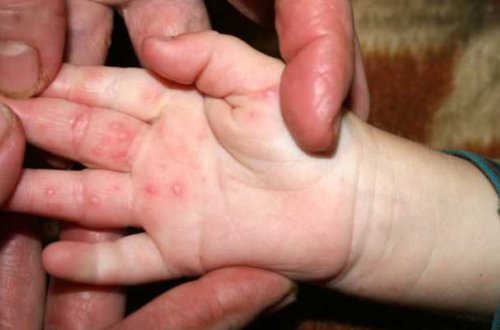 Bakıda suçiçəyinə bənzər virus yayılıb