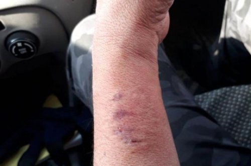 Millət vəkili polisin əlini dişlədi - FOTO (VİDEO)