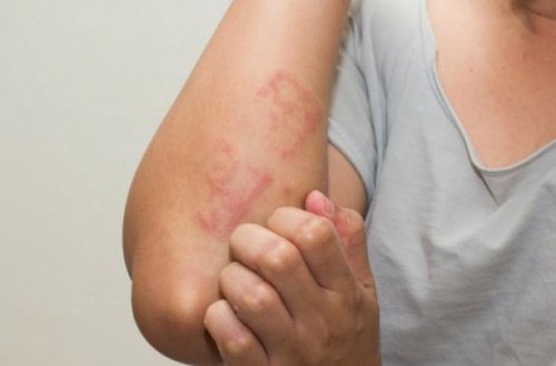 Şəhərdə yaşayanların allergiyadan daha çox əziyyət çəkməsinin səbəbləri