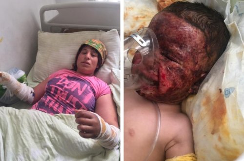 Маленькая Анжела пострадала при пожаре в доме. Надежда на ее спасение есть. Нужна ваша помощь!