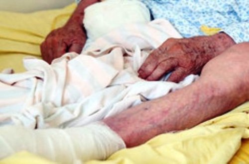 Ayağı amputasiya olunan xalq artistinin digər ayağı da kəsiləcək? - HƏKİMİ DANIŞDI