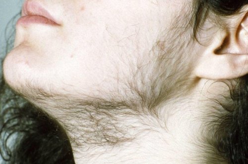 Çənədəki tüklərdən qurtula bilmirsinizsə... - Səbəblərini öyrənin, xəstəlik əlamətidir...