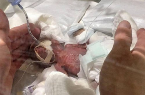 Dünyanın ən balaca körpəsi Yaponiyada doğuldu – Foto