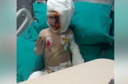 Üzünə benzin töküb yandırılan 2 yaşlı uşağın xəstəxanadan SON GÖRÜNTÜSÜ - ÜRƏKPARÇALAYAN VİDEO
