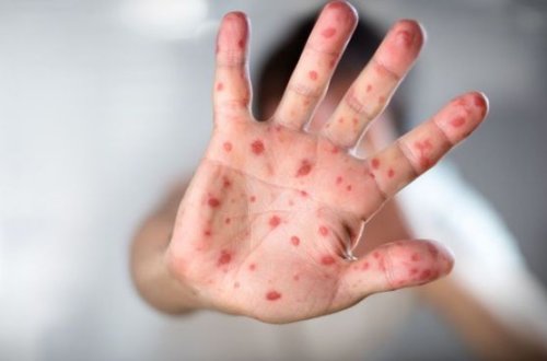 Səhiyyə nazirindən qızılca xəstəliyi ilə bağlı - ƏMR