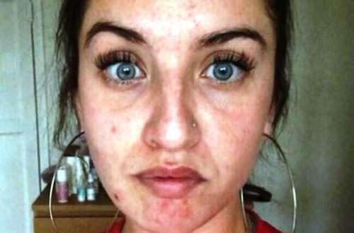 Üzündə ləkələr yaranan 29 yaşlı qadın həkimə getdi, eşitdiklərindən şoka düşdü - FOTOLAR