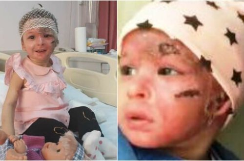 Bakıda üzünə benzin tökülən uşaq 8 əməliyyatdan sonra bu haldadır - SON VİDEO