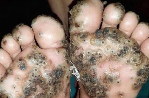 Qum birələri 10 yaşlı qızın ayaqlarını yedi