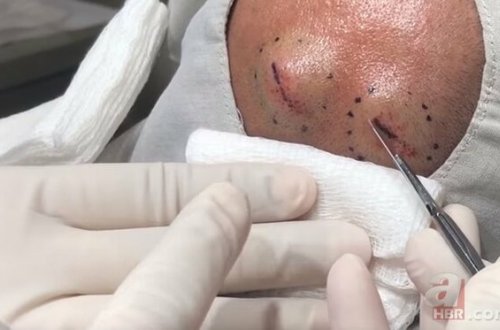 Başındakı şişə görə həkimə getdi, nəticədən şoka düşdü - FOTOLAR