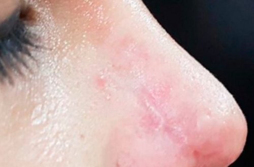 Azərbaycanda dəhşət: kosmetoloq qızın burnunu çürütdü - FOTO