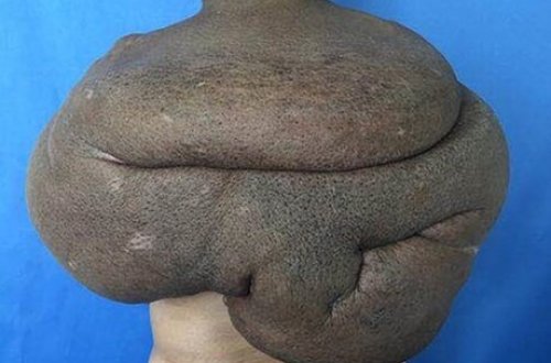 15 kiloqramlıq şiş bütün kürəyinə yayıldı /FOTO