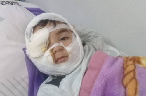 Бешеная собака разодрала лицо 4-летнего ребенка – ФОТО (18+)