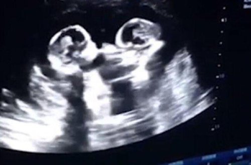 Ana bətnindəki əkizlərin bir-birinə etdiyi bu hərəkət hamını ŞOKA SALDI - İNANILMAZ - VİDEO