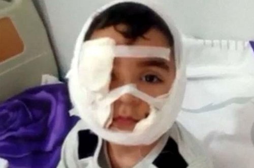 Üzünü it parçalayan uşağın atası: Oğlumun üzünü əməliyyat etdilər, lakin...