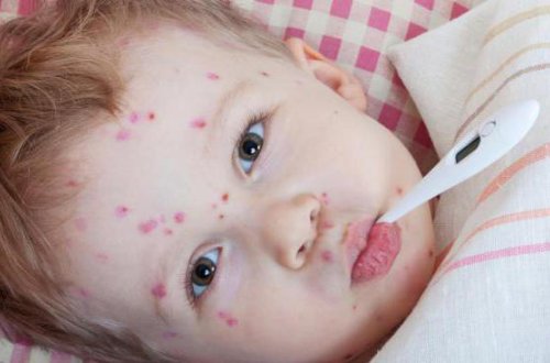 В Азербайджане уменьшилось число случаев заражения корью